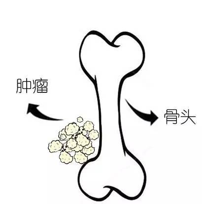 骨腫瘤的聚焦超聲消融手術治療