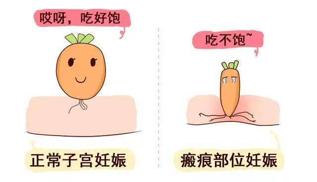 瘢痕妊娠的聚焦超聲消融手術治療