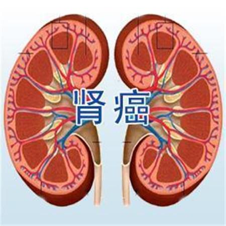 什么是腎癌？