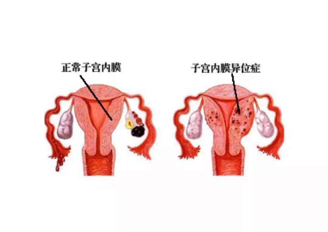 子宮內膜異位癥的聚焦超聲消融手術治療