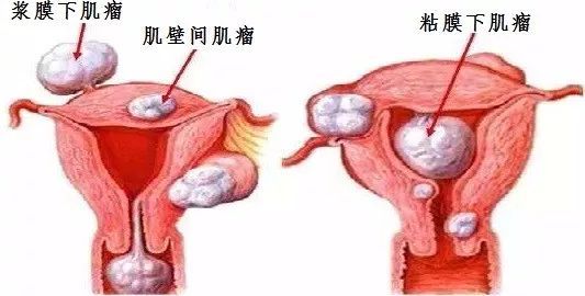 子宮肌瘤的聚焦超聲消融手術治療