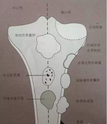 骨腫瘤是什么病，癥狀有哪些？