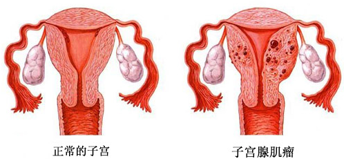 子宮腺肌病——“不死的癌癥”