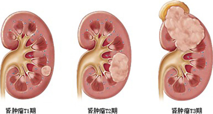 有吸煙習慣的人患胰腺癌的可能性是不吸煙的人的2至3倍