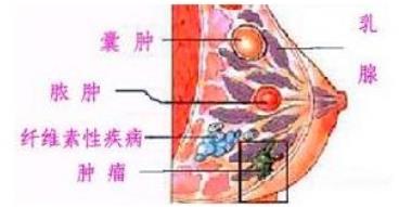 乳腺癌的癥狀有哪些？如何治療？