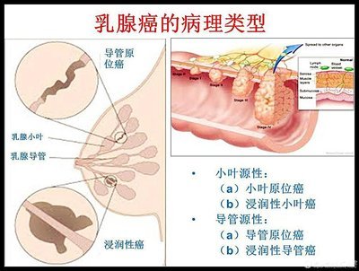 胰腺癌容易發生在老年人身上，其中大多數發生在60歲以上的人群中
