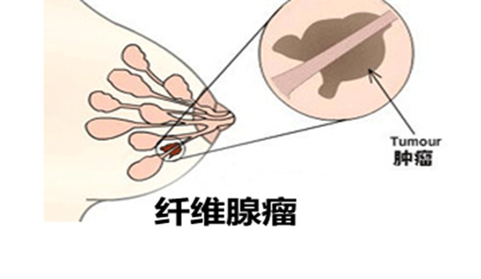 聚焦超聲消融手術治療乳腺纖維瘤