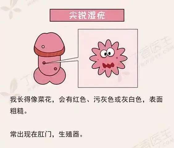 海極星?治療尖銳濕疣