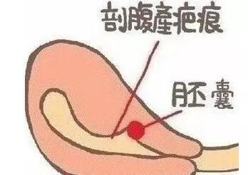 有關(guān)子宮肌瘤的病因迄今仍不十分清楚