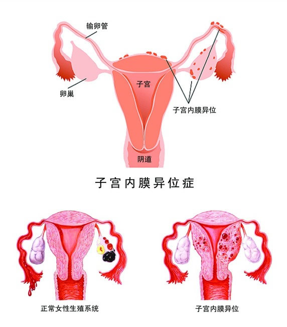 子宮內(nèi)膜異位癥