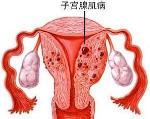 有關子宮肌瘤的病因迄今仍不十分清楚