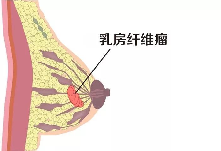 什么是乳腺纖維瘤？